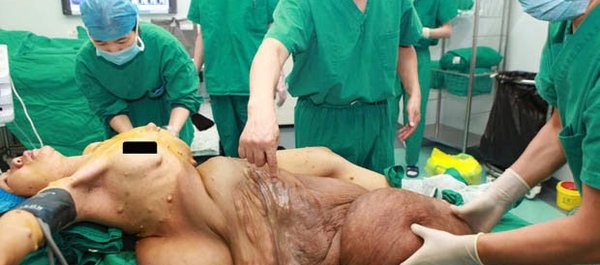 Médicos retiram tumor do tamanho de uma criança de dentro de mulher