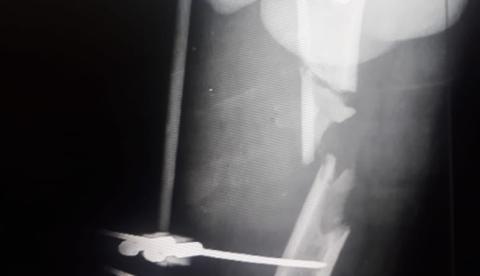 Falta de material em hospital deixa paciente sem cirurgia há quase 2 anos