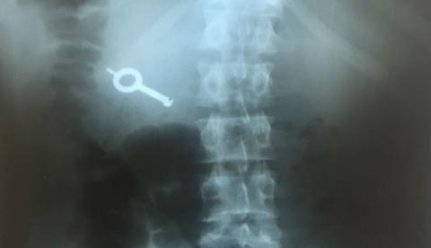 Raio-X mostra chave engolida por preso durante rebelião no Paraná