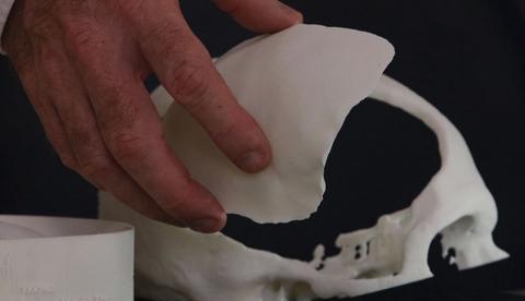 Brasileiros desenvolvem tecnologia de reconstrução craniana