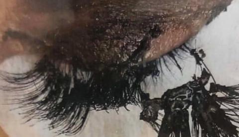 Cílios postiços podem causar queimaduras durante exame