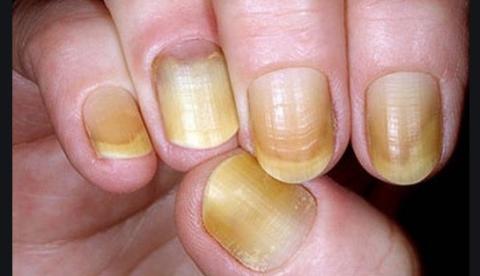 Veja o que fazer para clarear unhas amareladas pelo esmalte