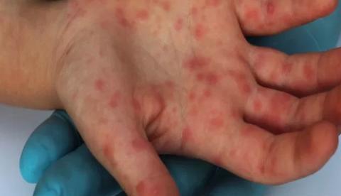 Em Manaus, bebê e outras três pessoas são diagnosticadas com sarampo