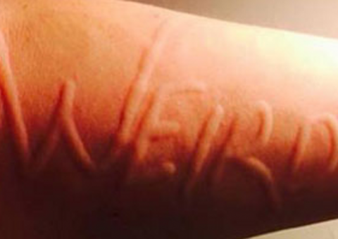 Mulher com rara doença de pele se sente como um caderno de desenho