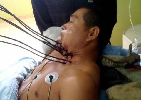 Homem sobrevive após perfurar pescoço com sete barras de metal