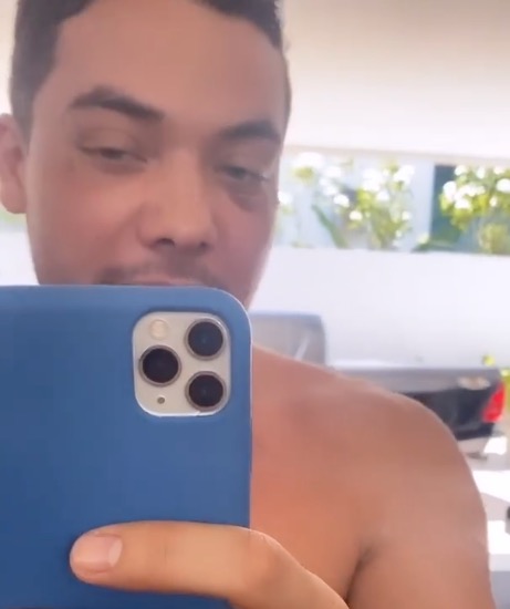 Sertanejo mostrou olho roxo ap&oacute;s procedimento - Foto: Reprodu&ccedil;&atilde;o/ Instagram 