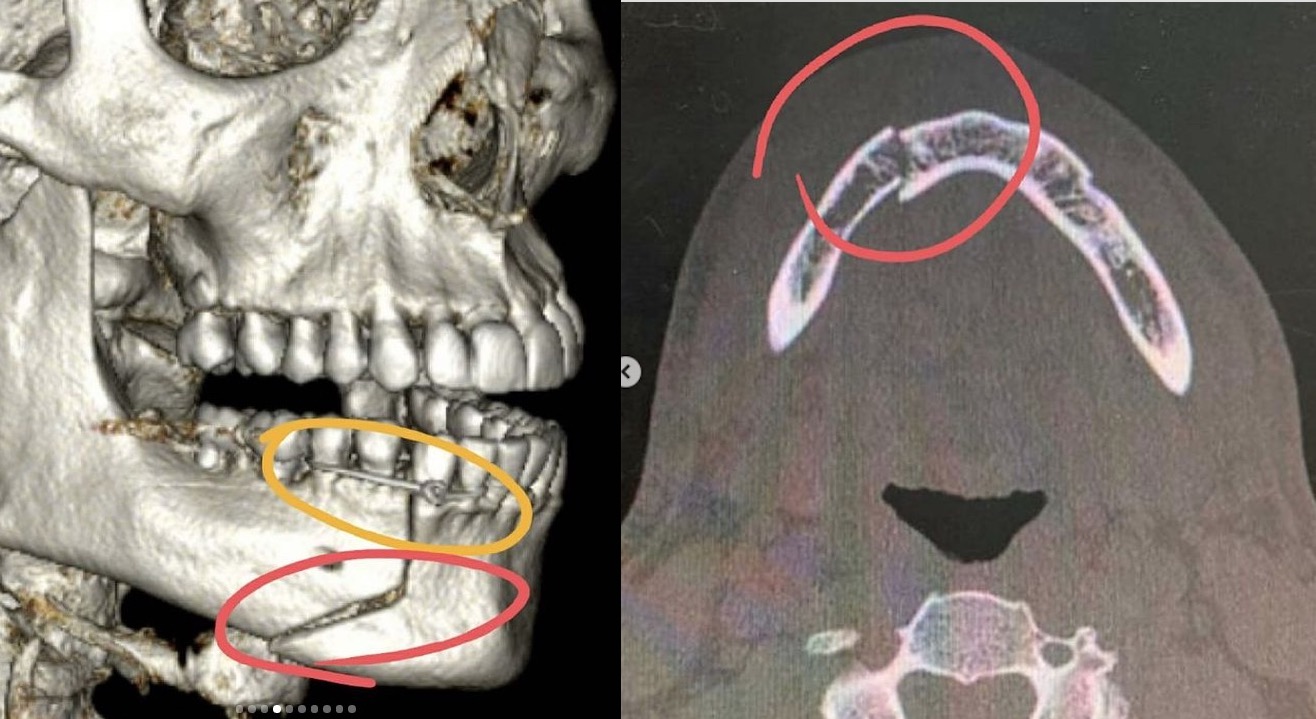 Mand&iacute;bula quebrada 