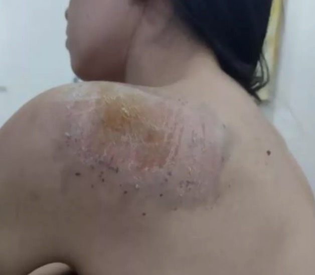 Estudante compartilhou machucado nas redes sociais - Foto: Reprodu&ccedil;&atilde;o/Instagram