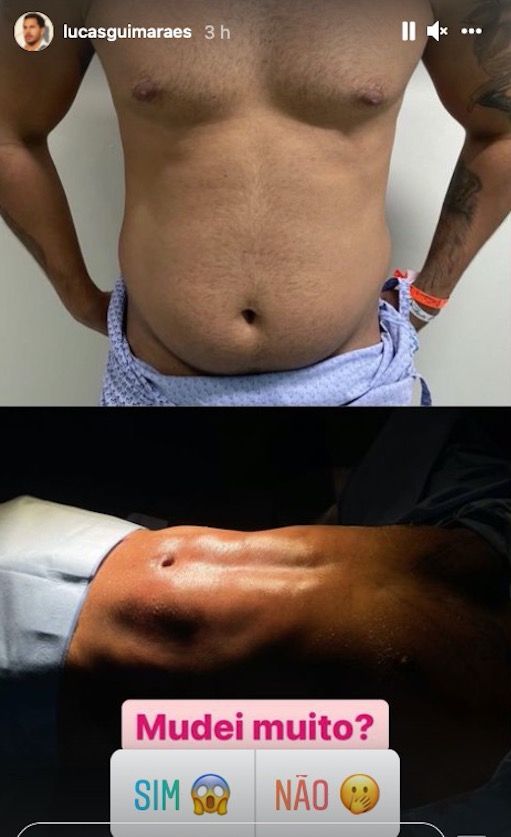 Lucas compartilhou com os seguidores resultado de lipo - Foto: Reprodu&ccedil;&atilde;o/Instagram