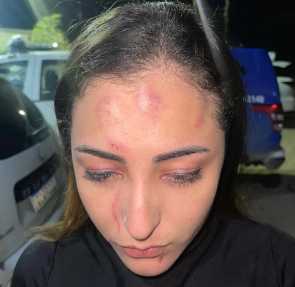 V&iacute;tima mostrou os hematomas - Foto: Divulga&ccedil;&atilde;o