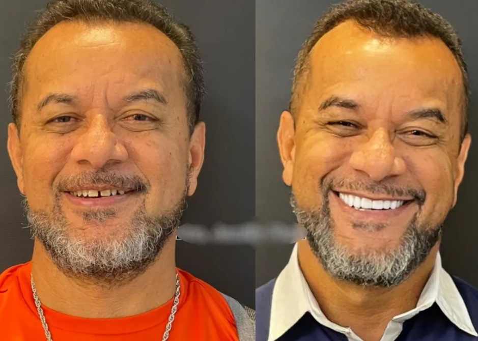 Luiz Carlos das Dores, de 56 anos, ap&oacute;s fazer as facetas dent&aacute;rias &mdash; Foto: Reprodu&ccedil;&atilde;o/TV Anhanguera