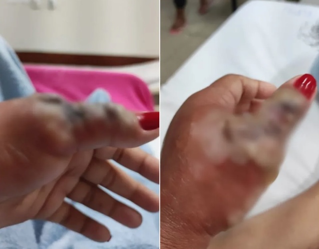 Evolu&ccedil;&atilde;o para necrose / Foto: Reprodu&ccedil;&atilde;o