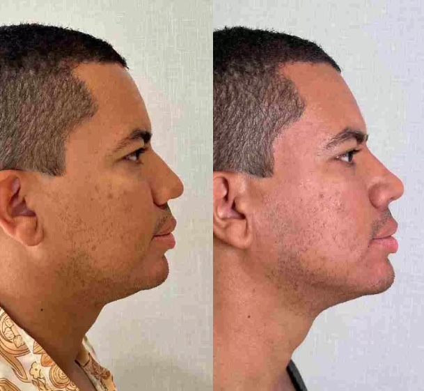 Antes e depois de Bruno Gaga - Foto: Divulga&ccedil;&atilde;o