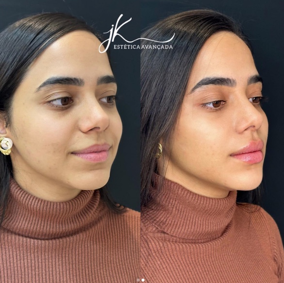 Antes e depois Mariely - Foto: Reprodu&ccedil;&atilde;o/Instagram Jk Est&eacute;tica Avan&ccedil;ada 