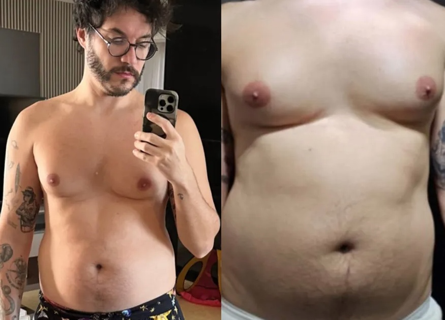 Eliezer antes da cirurgia - Imagens: Reprodu&ccedil;&atilde;o/Instagram
