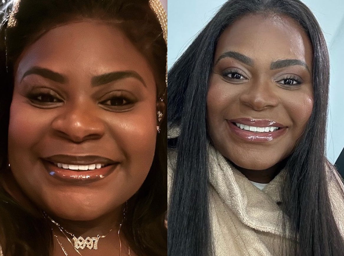 Antes e depois do procedimento - Foto: Reprodu&ccedil;&atilde;o/Instagram