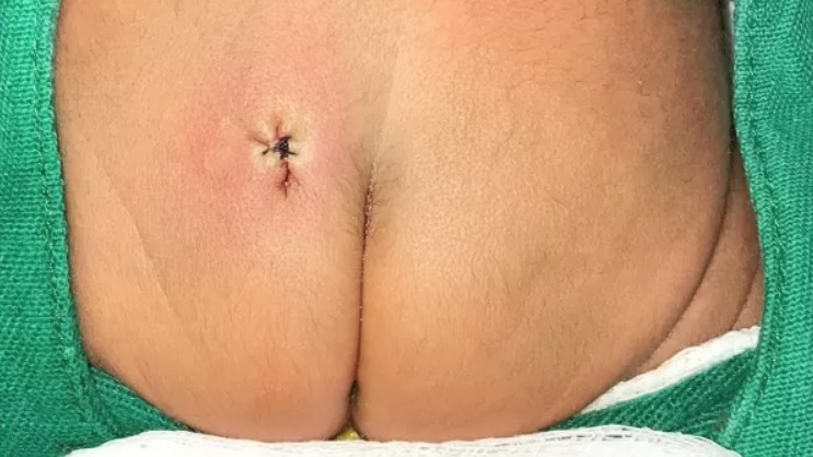 Foto: Reprodu&ccedil;&atilde;o/Journal of Pediatric Surgery Case Reports