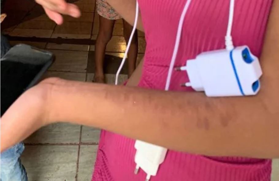 Menores mostram hematomas - Foto: Divulga&ccedil;&atilde;o