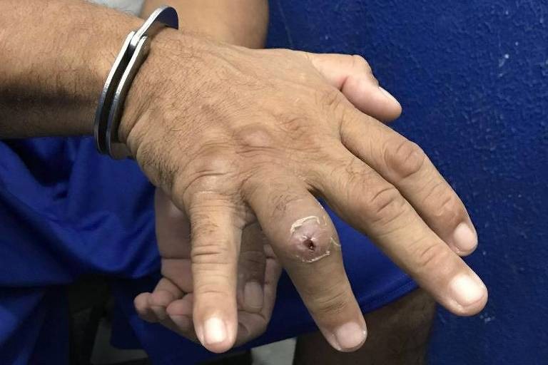Preso mostra dedo ferido por policiais penais durante a&ccedil;&atilde;o no Rio Grande do Norte, em 2017 - Divulga&ccedil;&atilde;o