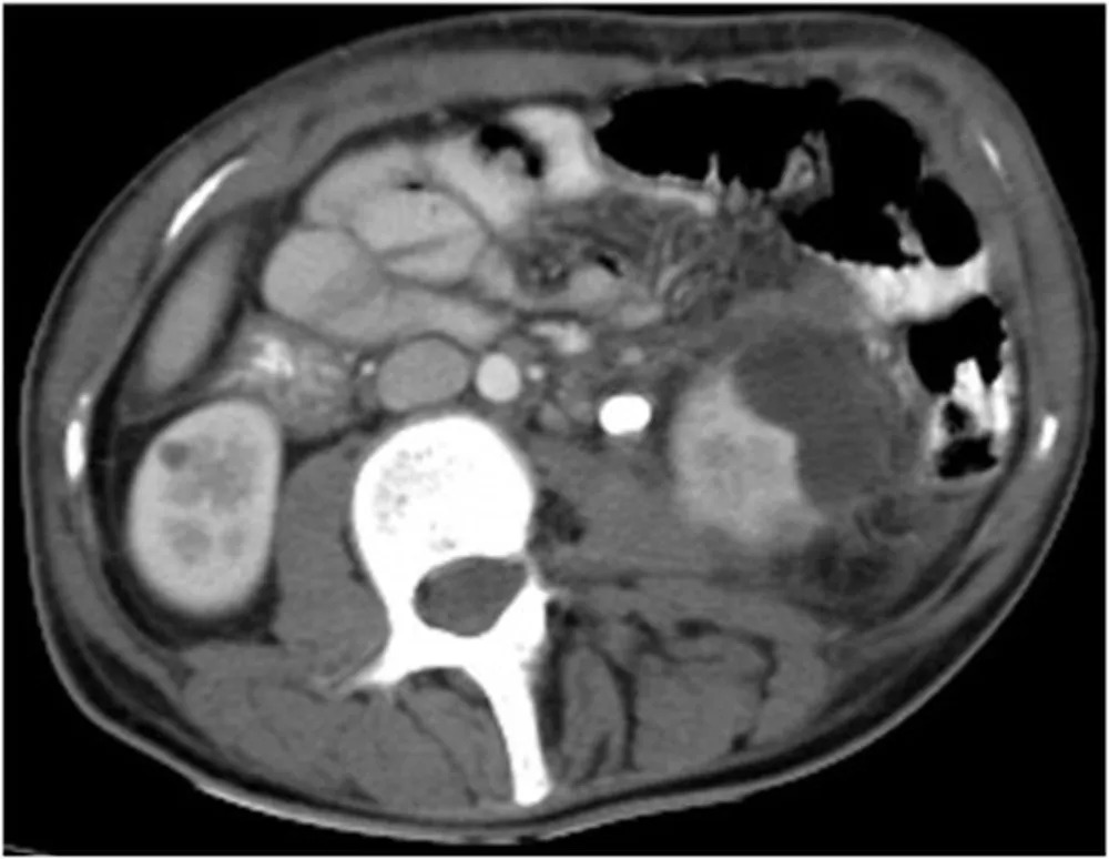 M&eacute;dicos removem pedra do tamanho de 'laranja' da vagina de uma mulher no L&iacute;bano &mdash; Foto: Reprodu&ccedil;&atilde;o / Urology Case Reports