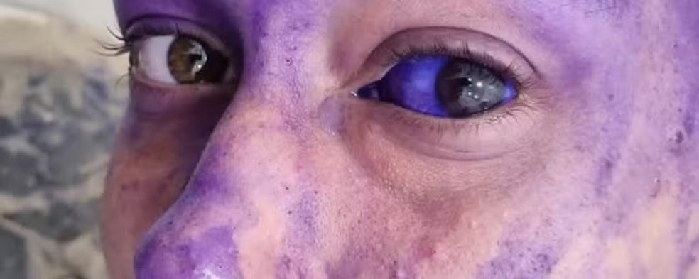 Calouro com contamina&ccedil;&atilde;o nos olhos ap&oacute;s contato com produto t&oacute;xico durante trote universit&aacute;rio em RO &mdash; Foto: Reprodu&ccedil;&atilde;o