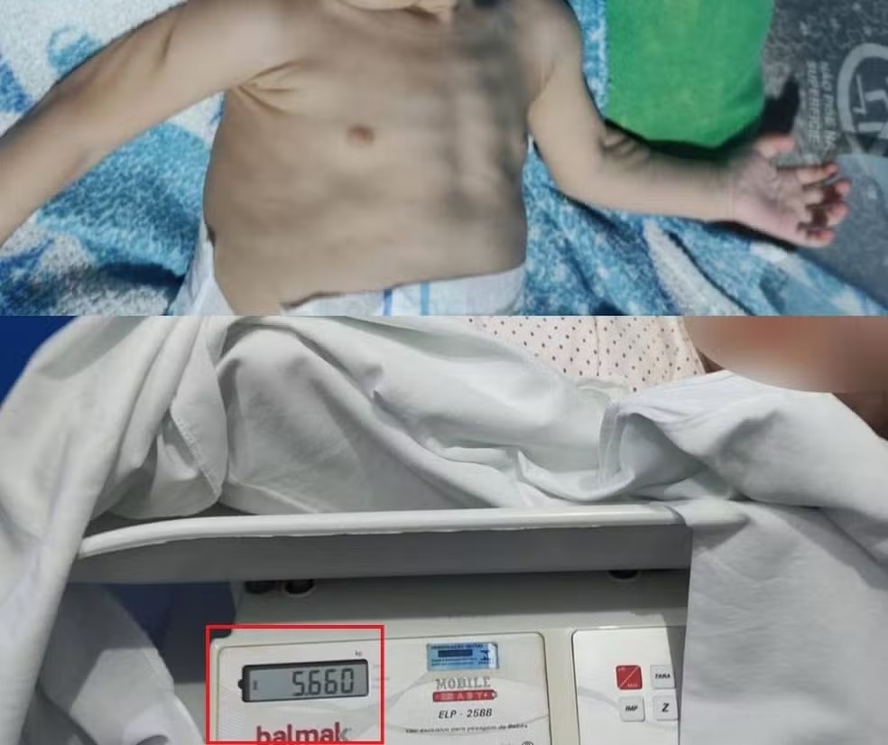 A crian&ccedil;a pesava 5,6 kg, sendo que um peso m&eacute;dio de um beb&ecirc; de 1 ano varia de 7kg a 11 kg. &mdash; Foto: Reprodu&ccedil;&atilde;o