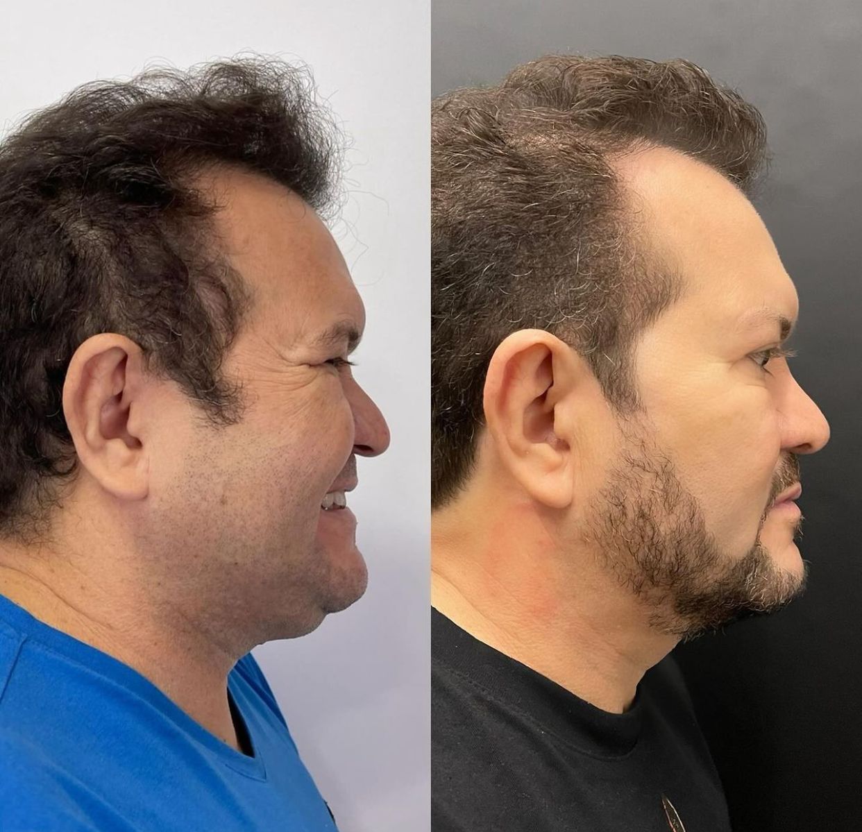 Antes e depois de Ximbinha - Foto: Reprodu&ccedil;&atilde;o/Instagram