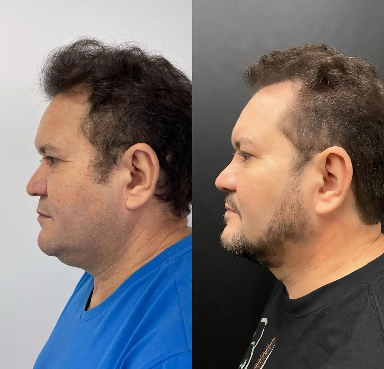 Antes e depois de Ximbinha - Foto: Reprodu&ccedil;&atilde;o/Instagram