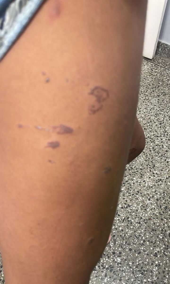 Adolescente foi queimada com pl&aacute;stico derretido - Foto: Divulga&ccedil;&atilde;o