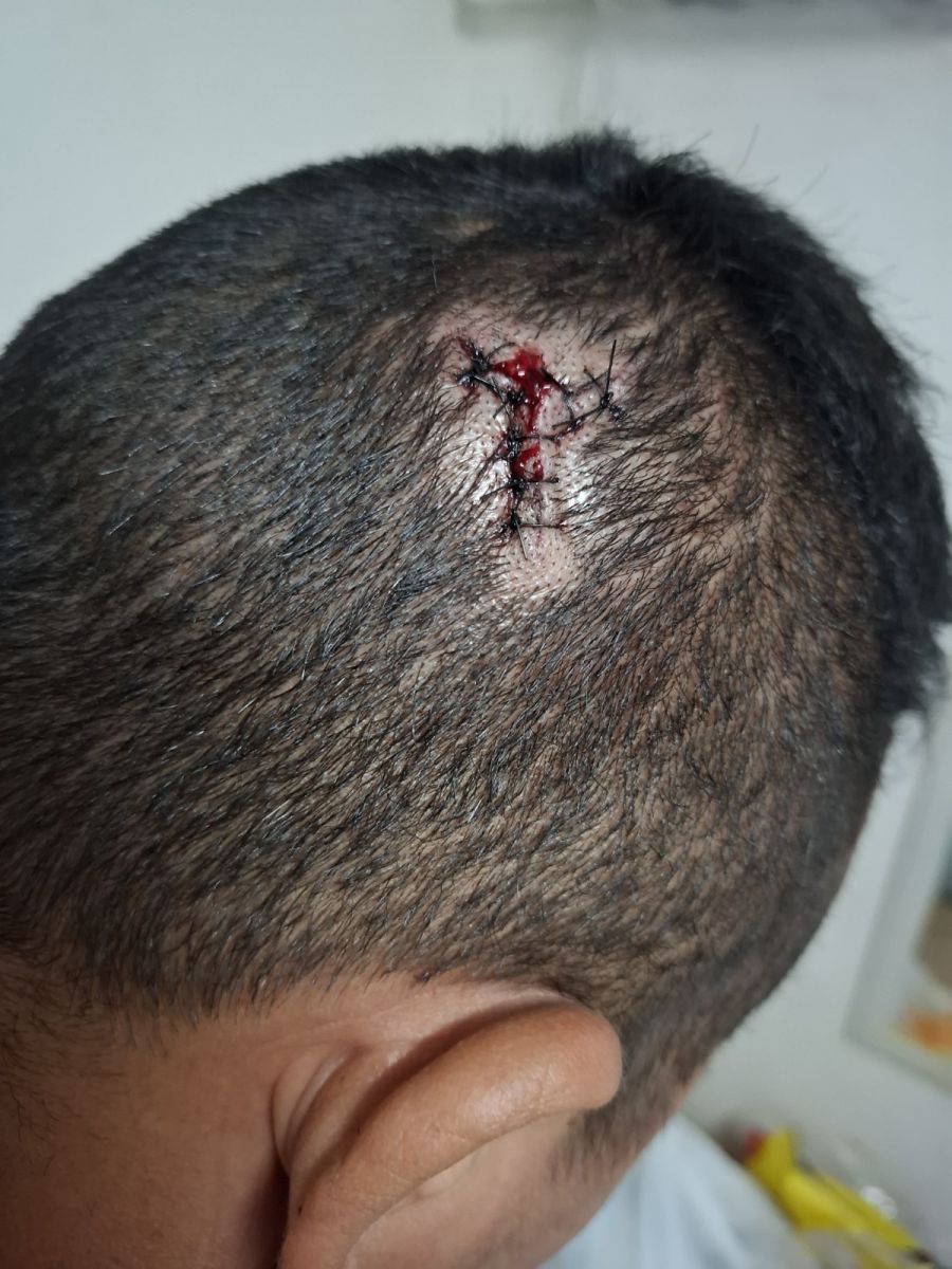 V&iacute;tima levou 8 pontos na cabe&ccedil;a - Foto: Divulga&ccedil;&atilde;o