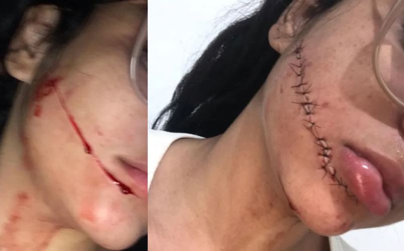 Corte mutilou a jovem da bochecha ao queixo - Foto: Divulga&ccedil;&atilde;o