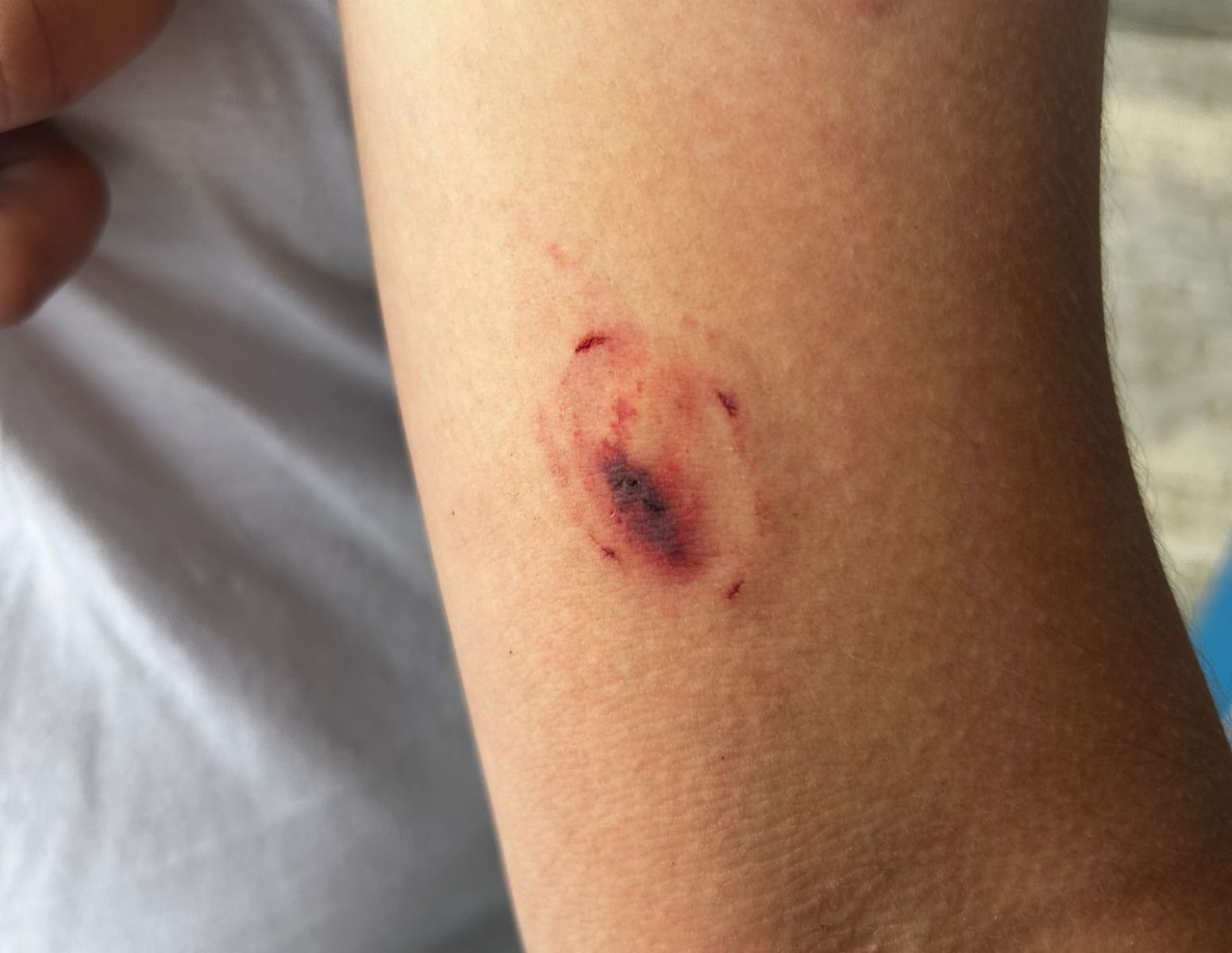 Primo mostra mordidas - Foto: Jander Robson/Portal do Holanda