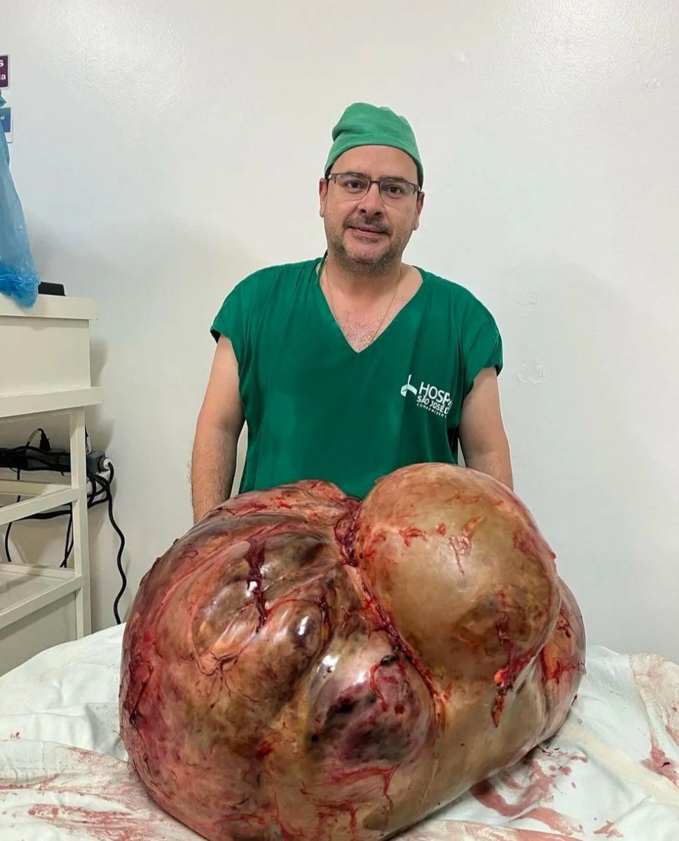 Tumor com cerca de 46 kg &eacute; retirado de paciente em Itaperuna, no RJ &mdash; Foto: Glaucio Boechat/arquivo pessoal