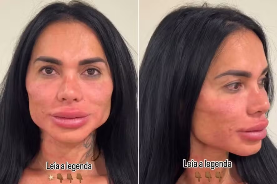 Kamila inchada ap&oacute;s o procedimento para remo&ccedil;&atilde;o do preenchimento labial. 