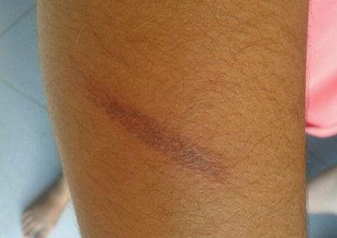 Mulher queima o braço em poste na Djalma Batista