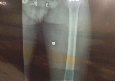 Assalto no Picanha Mania acaba com ladrão com tiro nas nádegas