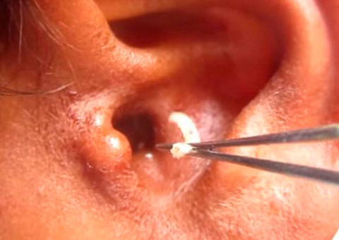  #Bizarro: jovem tem ouvido infestado por larvas após mosca depositar ovos