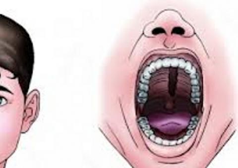  Fcecon diz que já restabeleceu cirurgias de palato