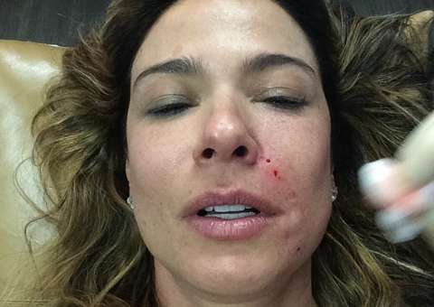 Luciana Gimenez usa o próprio sangue para fazer tratamento estético