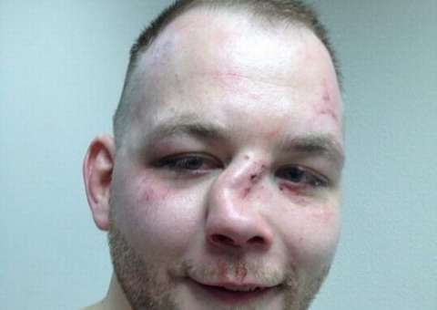 Lutador de MMA fica com nariz desfigurado após nocaute