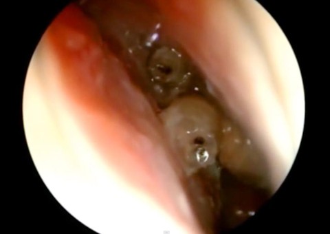  Médico remove larvas carnívoras do rosto de paciente e filma tudo