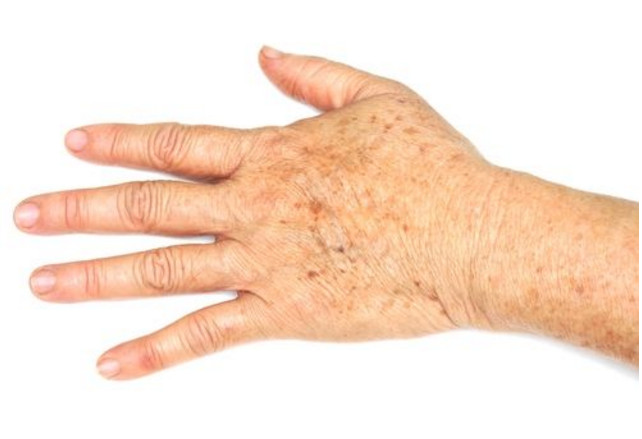  Apenas uma gota de óleo essencial para eliminar as manchas da pele