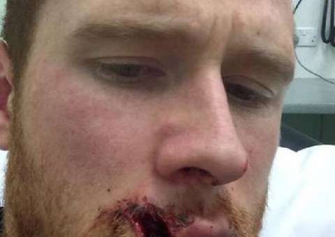  Jogador sofre ferimento grotesco, posta foto e faz piada