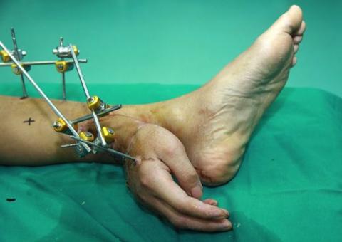 Médicos costuram mão de paciente no tornozelo