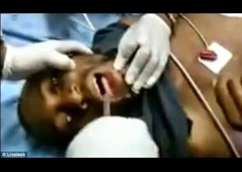 Homem fica engasgado ao engolir celular. Veja