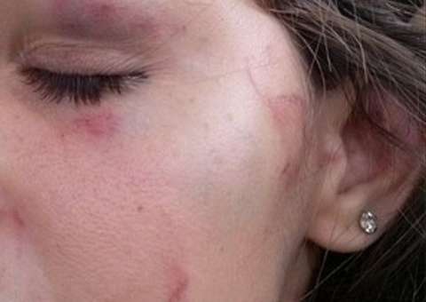 Estudante de 15 anos, foi espancada por duas meninas na saída da escola por ser bonita