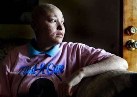 Doença misteriosa faz crescer unhas pelo corpo da jovem 