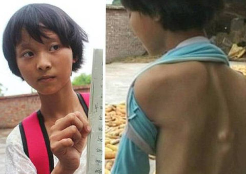 Doença rara transforma músculos e tendões em ossos