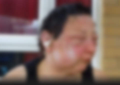 Mulher fica com rosto deformado após usar tintura de cabelo