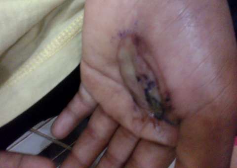 Comerciante é preso após queimar a mão do filho com ovo quente